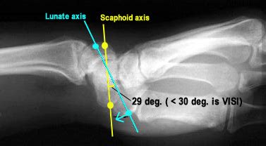 lt interosseous injury positive test